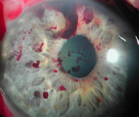 Алексеев И.Б.Рис. 6. Взвесь капелек крови в вискоэластике