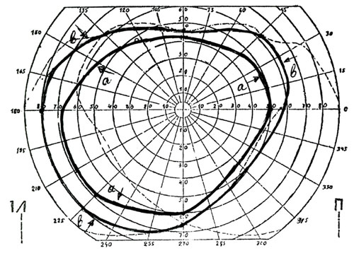 Больная Х. В. И., 62 года. ПЗ контралатерального (левого) глаза: а - до лечения, b - после лечения