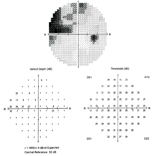 Больной Т. П. И., 52 года. ЦПЗ правого глаза через 6 мес. после лече-ния