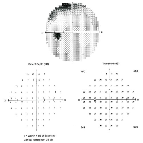 Больной Т. П. И., 52 года. ЦПЗ контралатерального (левого) глаза до лечения