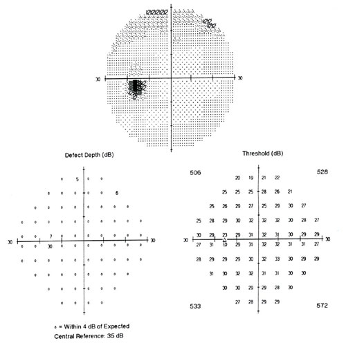 Больной Т. П. И., 52 года. ЦПЗ контралатерального (левого) глаза че-рез 2 мес. после лечения