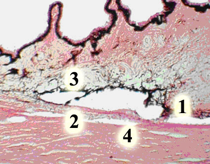 Экспериментальная глаукома. Изменение угла передней камеры глаза кролика при экспериментальной глаукоме Угол сужен за счет укорочения гребенчатой связки (1), корнеомышечная (2) и корнеоувеальная (3) части трабекулы атрофированы по толщине, шлеммов канал (