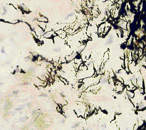 Экспериментальная глаукома. Выраженное тотальное отложение меланина в нервных волокнах цилиарного тела глаза кролика. Окраска по методу Фонтан-Массон, Ув.x180