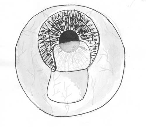  Отсепаровка лоскута конъюнктивы