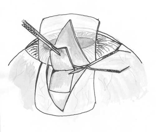 Удаление глубокого склерального лоскута