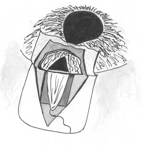 Вершина треугольного лоскута радужки подшивается к глубокой склеральной дуге