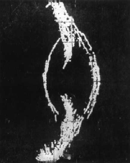 УЗИ - картина после операции