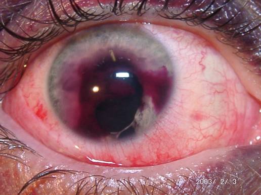 Постконтузионная гифема III 