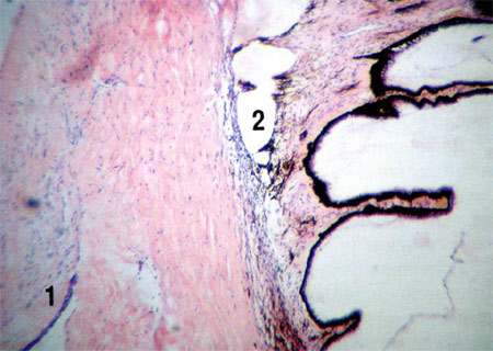 Гистологическая картина места имплантации дренажа в слои склеры. Срок - 3 недели: 1 - фрагмент тонкой капсулы, образовавшейся вокруг тела дренажа, 2 - угол передней камеры