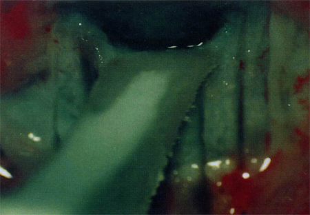 Меридиональные надрезы глубоких и средних слоев склеры