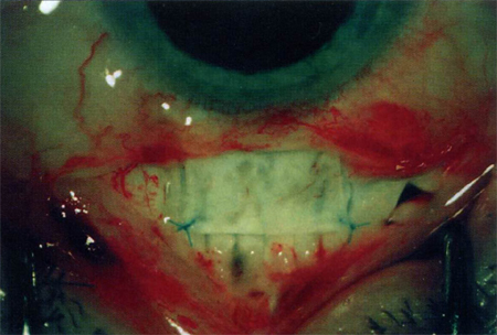 Узловые швы на углах склерального лоскута