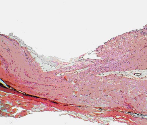 Экспериментальная глаукома, леченная препаратом  эрисод. Умеренно выраженная атрофия слоя аксонов ганглиозных клеток сетчатки вблизи диска зрительного нерва кроликов. Окраска гематоксилином и эозином. Ув.  180